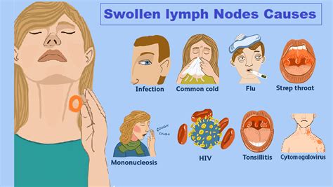 Swollen Lymph Nodes Glands Causes Picture Symptoms Treatment The Best Porn Website