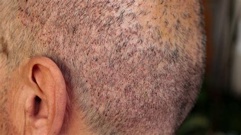 Top 109 Scalp Folliculitis After Hair Transplant
