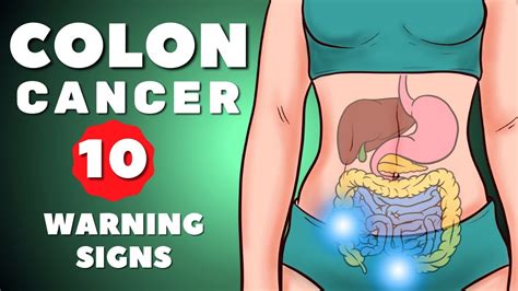 Colon Cancer Symptoms Colorectal Cancer 10 Warning Signs Of Colon Cancer Colon Cancer