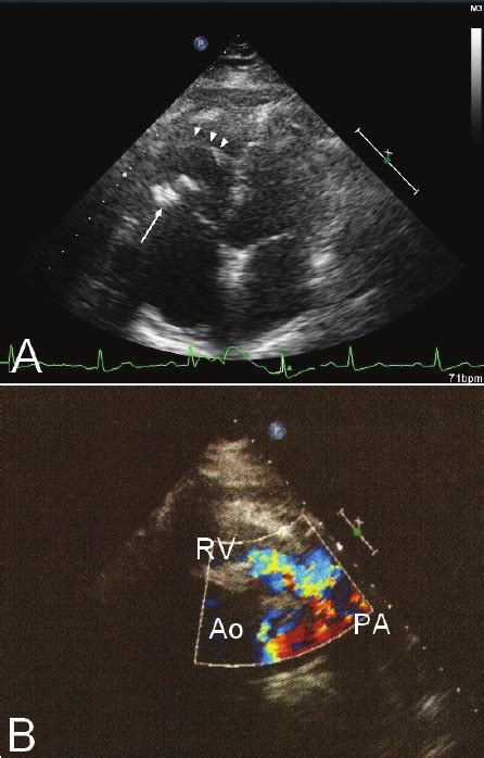 Transthoracic Echocardiography A Apical Four Chamber View Shows