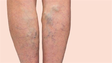 Varicose Veins May Be Genetically More Likely In Taller People Cnn