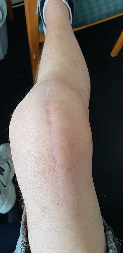 Maybe you would like to learn more about one of these? Knee Replacement Scar Recovery Timeline: A Photo Gallery