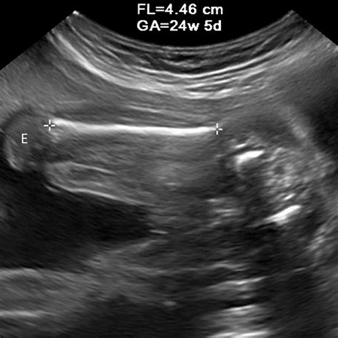 Sonographic Assessment Of Fetal Growth Abnormalities Radiographics