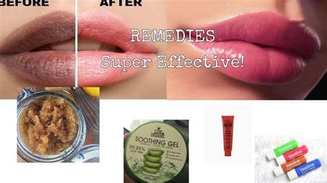 Easy Remedies For Dry And Peeling Lips Achieving Pink Lips Not So