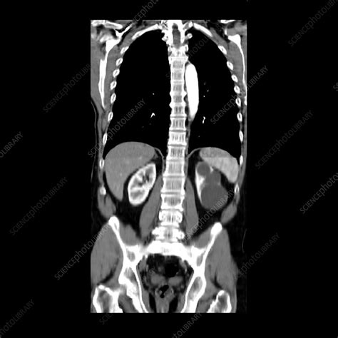 Ct Of Chest With Benign Cysts Stock Image M1300847 Science Photo