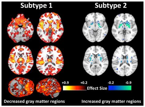 Mri Scans Of Schizophrenia Sub Image Eurekalert Science News Releases