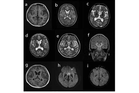 Representative Lesion Signal Intensity Of Brain Mri In The 68 Patients
