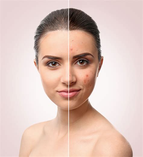 Acne Removal Cityslim And Laser Clinic