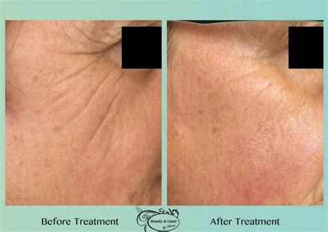 Clearlift 60 Min Face Lift Treatment Beauty And Laser