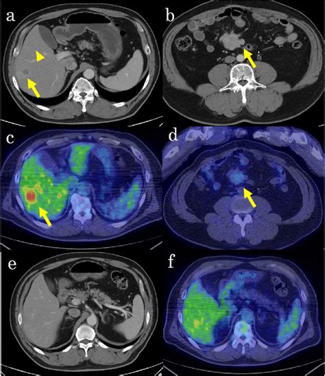 Contrast Enhanced Computed Tomography Ct And 18f Fluorodeoxyglucose