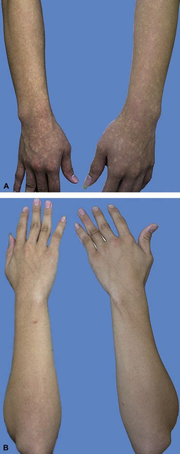 Acquired Disorders With Hypopigmentation A Clinical Approach To