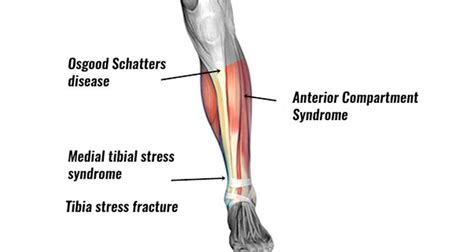 Lump On Lower Leg After Exercise Exercisewalls