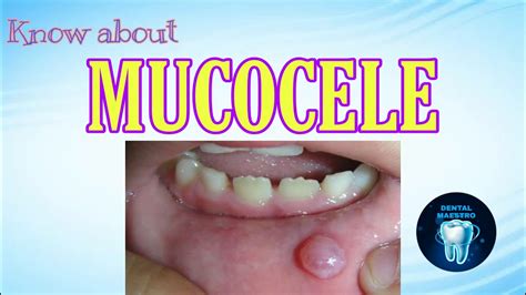 Mucocele Mucous Retention Cyst Mucous Escape Phenomenon Dental