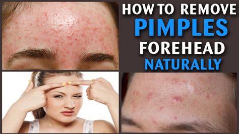 How To Remove Pimples On Forehead Naturally How To Get Rid Of Pimples