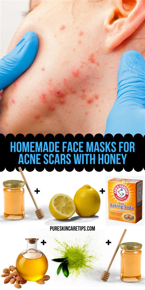 Tiny little bumps on the forehead. The Ultimate Guide To Diy Face Masks For Acne | Face Mask ...