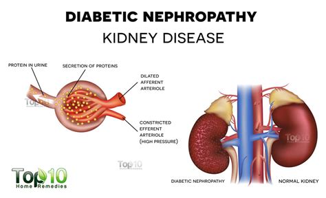 Tanda utama kerosakan buah pinggang ialah sakit pinggang (low back pain). Diabetes Penyebab Masalah Buah Pinggang | Vitamin Cerdik ...