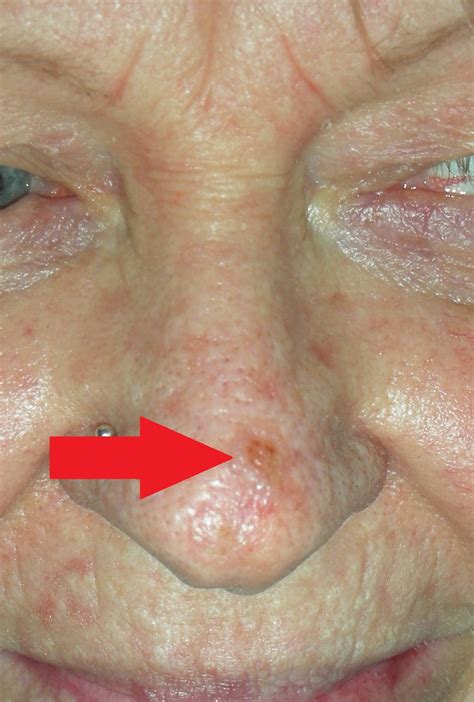 Skin Cancer Nose With Local Flap Repair Dr Damian Marucci Cosmetic