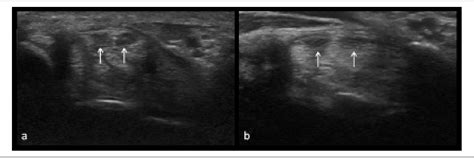 Figure 4 From Sonographic Representation Of Bifid Median Nerve And