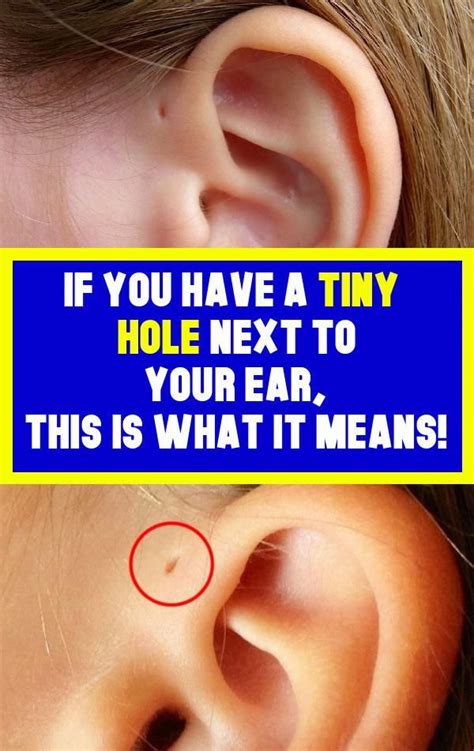 If You Have A Tiny Hole Next To Your Ear This Is What It Means