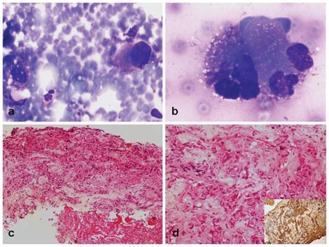 Ab Fine Needle Aspiration Cytology Of The Breast Lesion Showed