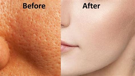 How To Get Rid Of Open Pores On Skin Permanently In One Day Youtube