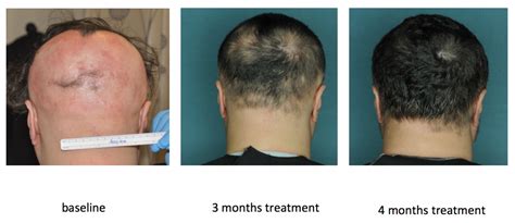 Drug Restores Hair Growth In Patients With Alopecia Areata Columbia University Department Of