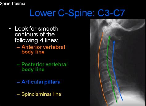 Radiology Of Cervical Spine In The Trauma Setting