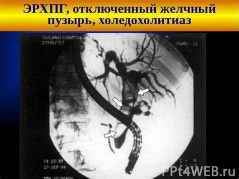 Диета мочекаменная болезнь почек