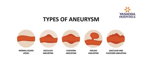 Aneurysms Its Causes Symptoms Diagnosis And Treatment