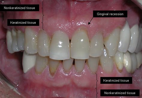 Do You Have Gum Recession Gingival Recession Globaldentalpro
