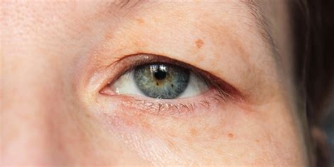 Eyelid Drooping What Is It And The Reasons Symptoms And Treatment