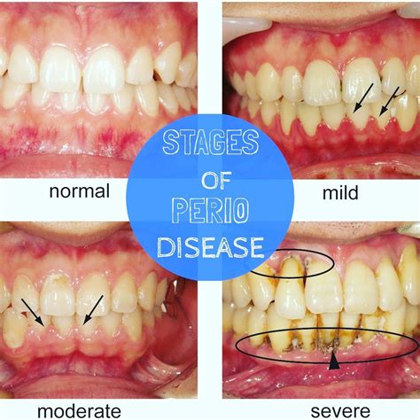 Stages Of Perio Disease Odontología