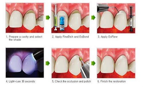 Esflow Flowable Composite Dental Supplies And Instruments