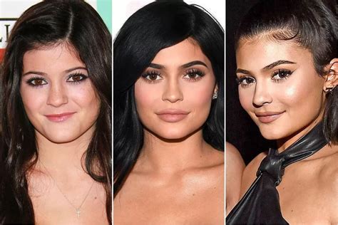 Kylie Jenner Before And After Plastic Surgery Mayclinik
