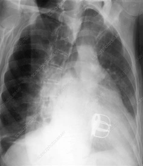 Prosthetic Heart Valves X Ray Stock Image M5610092 Science