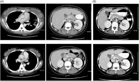 Axial Images Of Contrast Enhanced Chest And Abdominal Ct In The First