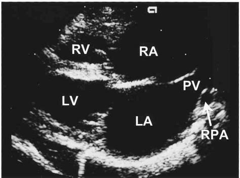 Echocardiogram Right Parasternal Long Axis View Marked Biatrial