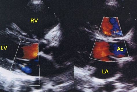 Echocardiogram In Severe Pulmonary Hypertension All About
