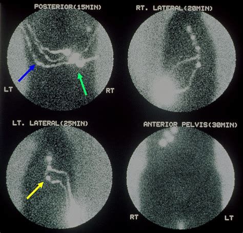 Lymphoscintigraphy And Sentinel Nodes Journal Of Nuclear Medicine