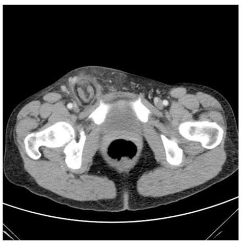 Hernia Diagnosis Ct Scan Ct Scan Machine Images