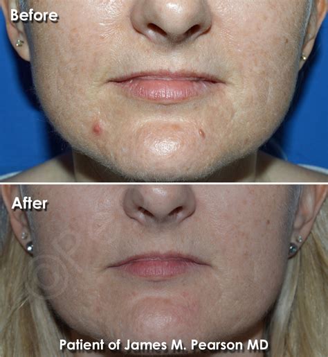Mole Removal Photos Before And After Dr James Pearson Facial Plastic