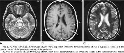 Pdf Subcortical White Matter Lesions In Osmotic Demyelination