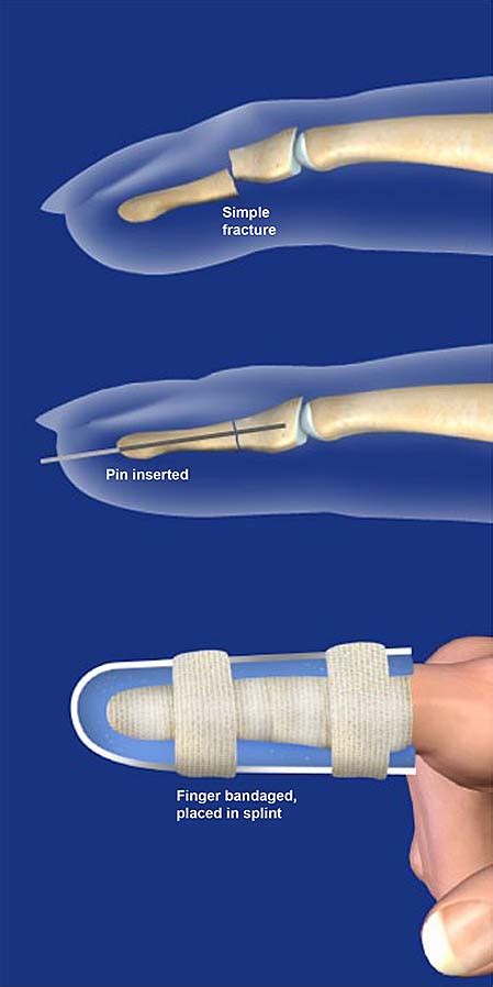 Finger Fracture Fixation Central Coast Orthopedic Medical Group