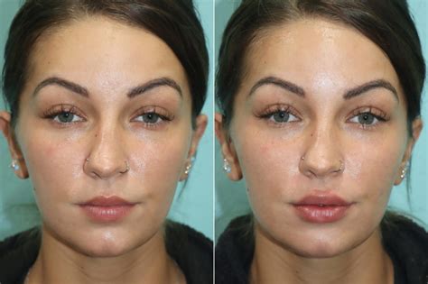 Injections Lip Injections Photos Chevy Chase Md Patient