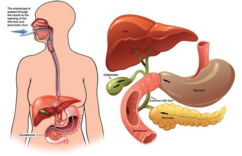 It may benefit people with cancer by reducing symptoms of the disease and its treatment. ERCP (Endoscopic Retrograde Cholangio-Pancreatography ...