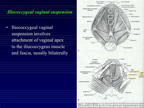 Operations For Nulliparous Prolapse And Vaginal Vault Prolapse Mob