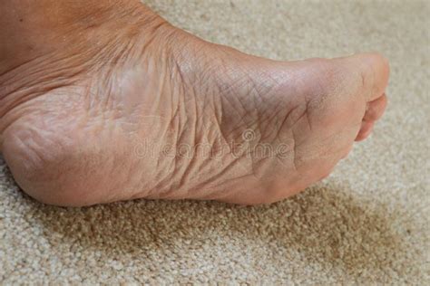 Sore Cracked Dry Skin On Feet Dry Dehydrated Feet Of A Lady Stock Image Image Of Skin