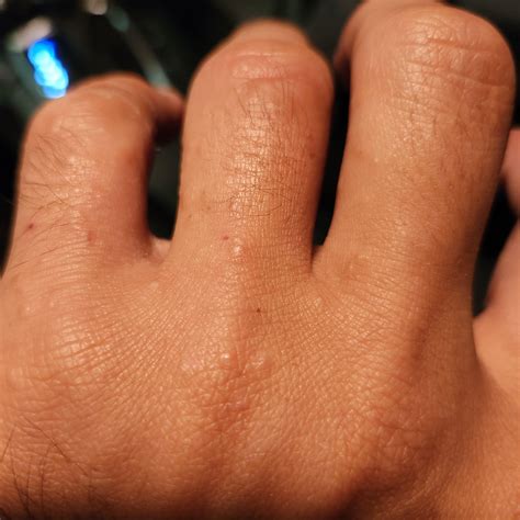 Dozens Of Itchy Bumps On Both Hands Rdermatology