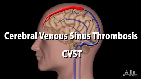 How To Spot And Treat Cerebral Venous Sinus Thrombosis Acep Now My Xxx Hot Girl
