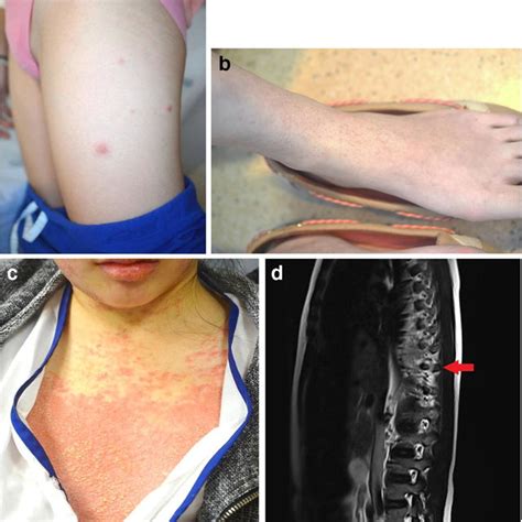 A Case 1 Multiple Tender Erythematous Sweets Syndromelike Nodules